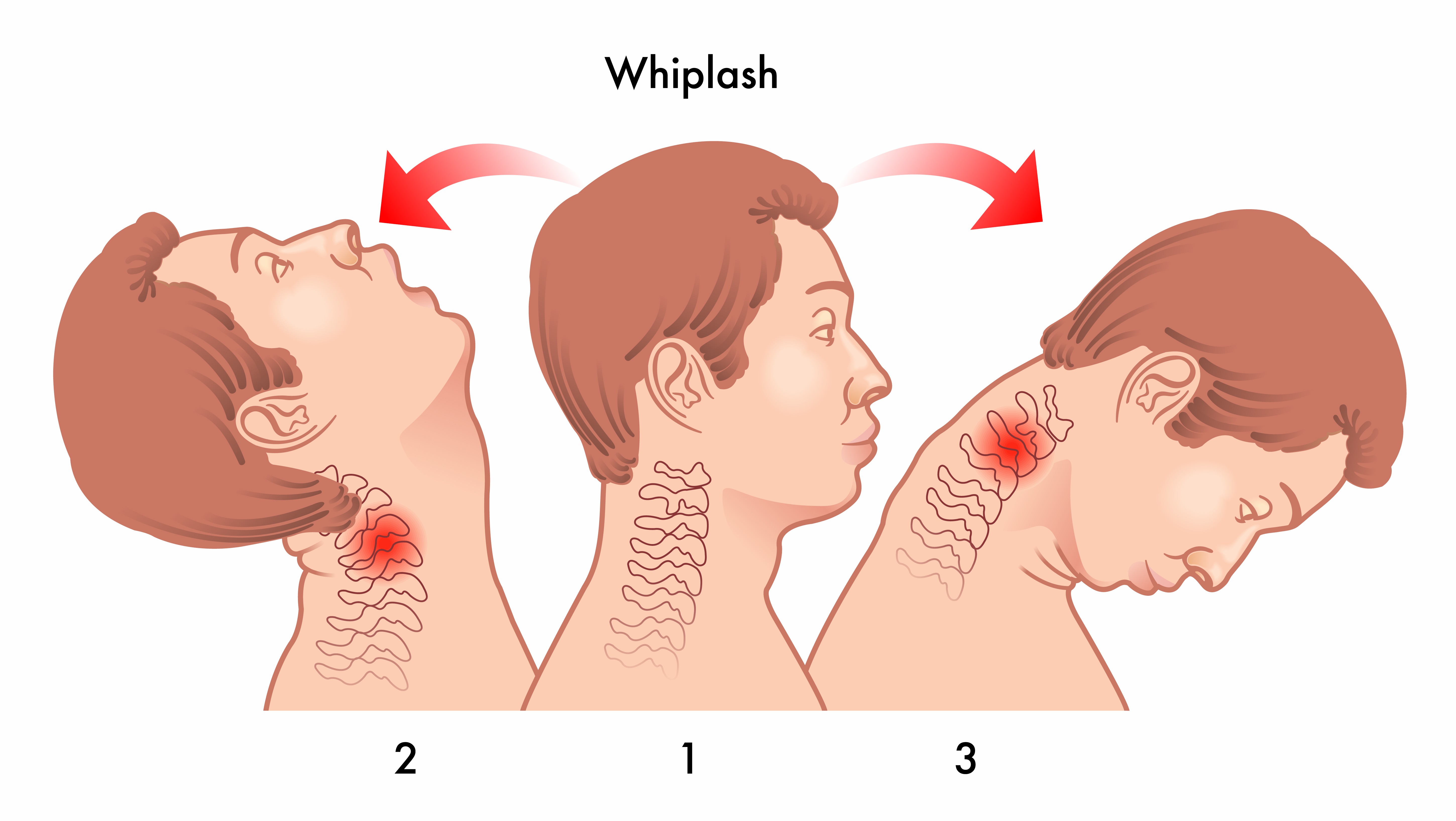 Illustration of whiplash