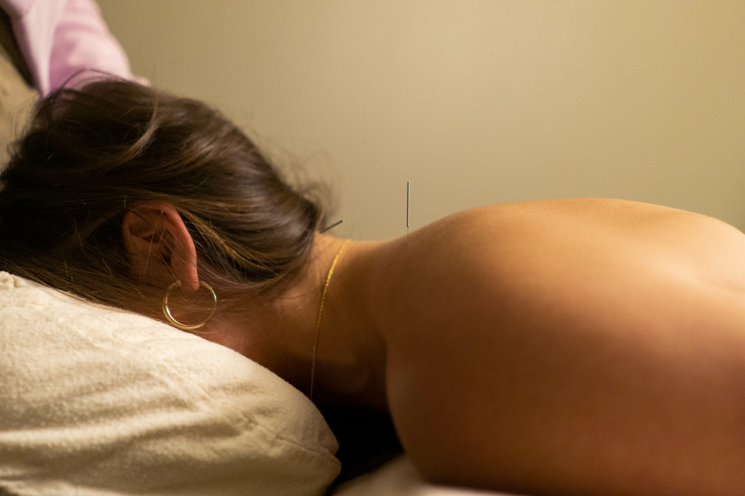 Acupuncture for Sleep – So Long, Insomnia 