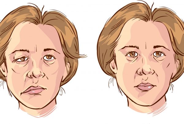Acupuncture Treatment for Bell’s Palsy