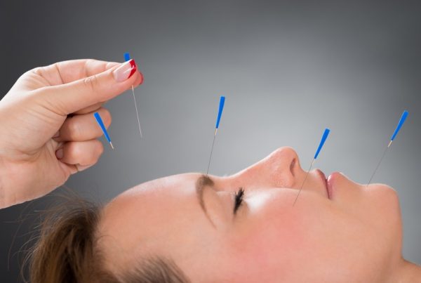 women acupuncture