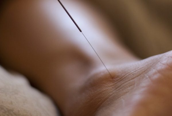 Acupuncture for Runners
