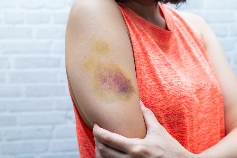 Mysterious Bruises…Find Out Why